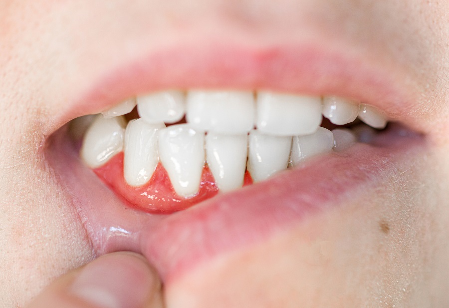 When Should You be Concerned about Bleeding Gums?
