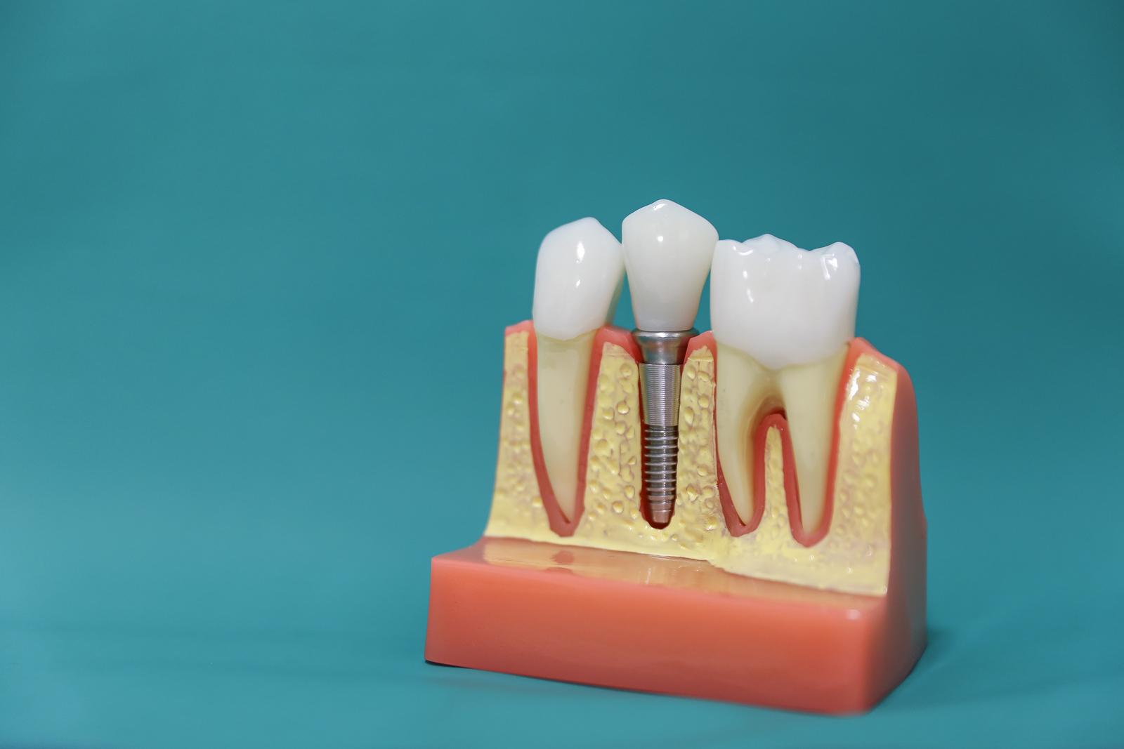 Why Choose Dental Implants?
