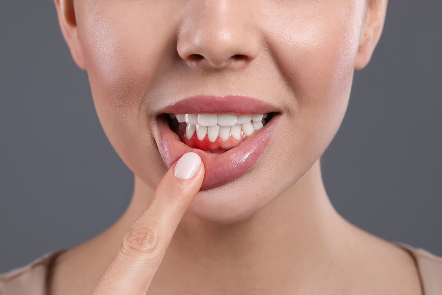 Ways to Prevent Gum Disease