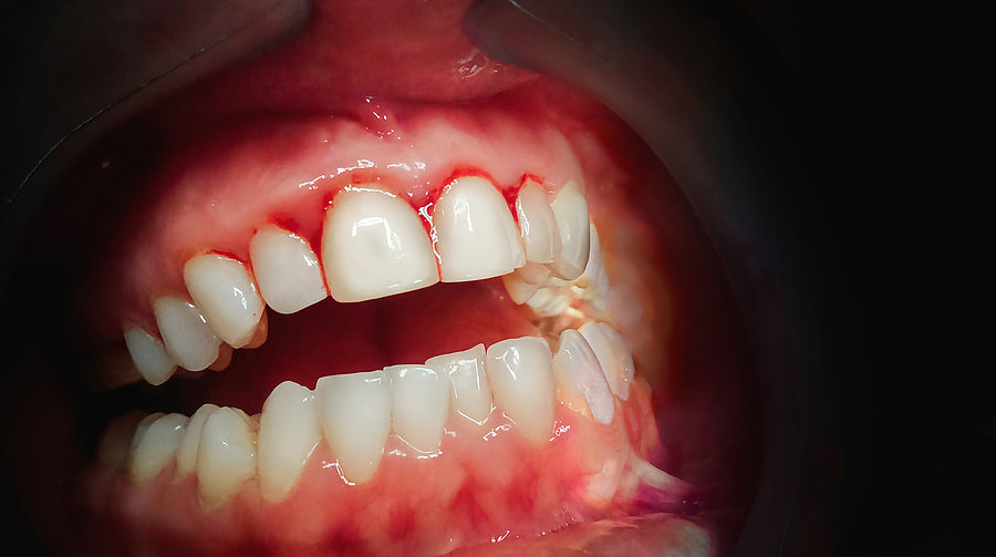 Understanding Bleeding Gums in Mission Viejo, CA: Causes, Treatment, and Prevention